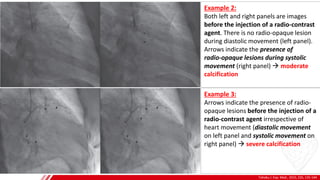 Tohoku J. Exp. Med., 2015, 235, 135-144
A
B
Example 2:
Both left and right panels are images
before the injection of a radio-contrast
agent. There is no radio-opaque lesion
during diastolic movement (left panel).
Arrows indicate the presence of
radio-opaque lesions during systolic
movement (right panel) → moderate
calcification
Example 3:
Arrows indicate the presence of radio-
opaque lesions before the injection of a
radio-contrast agent irrespective of
heart movement (diastolic movement
on left panel and systolic movement on
right panel) → severe calcification
 