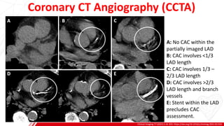 Coronary CT Angiography (CCTA)
Clinical Imaging 77 (2021) 1–8. DOI: https://doi.org/10.1016/j.clinimag.2021.02.016
A
B
A: No CAC within the
partially imaged LAD
B: CAC involves <1/3
LAD length
C: CAC involves 1/3 –
2/3 LAD length
D: CAC involves >2/3
LAD length and branch
vessels
E: Stent within the LAD
precludes CAC
assessment.
 