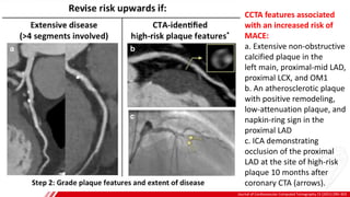 Journal of Cardiovascular Computed Tomography 15 (2021) 290–303
A
B
CCTA features associated
with an increased risk of
MACE:
a. Extensive non-obstructive
calcified plaque in the
left main, proximal-mid LAD,
proximal LCX, and OM1
b. An atherosclerotic plaque
with positive remodeling,
low-attenuation plaque, and
napkin-ring sign in the
proximal LAD
c. ICA demonstrating
occlusion of the proximal
LAD at the site of high-risk
plaque 10 months after
coronary CTA (arrows).
 