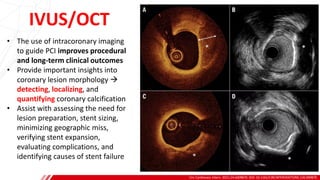 IVUS/OCT
Circ Cardiovasc Interv. 2021;14:e009870. DOI: 10.1161/CIRCINTERVENTIONS.120.009870
A
B
• The use of intracoronary imaging
to guide PCI improves procedural
and long-term clinical outcomes
• Provide important insights into
coronary lesion morphology →
detecting, localizing, and
quantifying coronary calcification
• Assist with assessing the need for
lesion preparation, stent sizing,
minimizing geographic miss,
verifying stent expansion,
evaluating complications, and
identifying causes of stent failure
 
