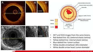 OCT/IVUS
J Am Coll Cardiol Img. 2017 Dec, 10 (12) 1487–1503
A
B
• OCT and IVUS images from the same lesions
• Red dotted line: EEL (external elastic lamina)
• Yellow dotted line: internal elastic lamina
• Blue dotted line: lumen surface
• Yellow double arrowhead: (EEL) diameter
• White double arrow head: Lumen diameter
 
