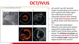OCT/IVUS
J Am Coll Cardiol Img. 2017 Dec, 10 (12) 1487–1503
A
B
• (A’) and (A’’) are OCT and IVUS
images corresponding to the arrow in
(A) in a patient with stable angina
who suffered peri-procedural
myocardial infarction after stenting
• A’: a large lipid rich plaque defined
by diffuse border with attenuation by
OCT
• A’’: a large attenuated plaque
defined as echo attenuation without
hyperechoic leading edge by IVUS
• B (OCT) and B’ (IVUS) show calcified
plaque. The thickness of calcium can
be measured only by OCT (1.05 mm),
and the calcium angle measured 130
degree by both IVUS and OCT.
 
