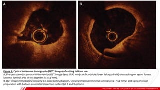 CUTTING
BALLOON
Am J Cardiol . 1995 Sep 1;76(7):518-20. doi: 10.1016/s0002-9149(99)80143-x.
B
Figure 6. Optical coherence tomography (OCT) images of cutting balloon use.
A, Pre-percutaneous coronary intervention OCT image deep (0.90 mm) calcific nodule (lower left quadrant) encroaching on vessel lumen.
Minimal luminal area in this segment is 3.51 mm2.
B, OCT image immediately following 1:1 sized cutting balloon, showing improved minimal luminal area (7.52 mm2) and signs of vessel
preparation with balloon-associated dissection evident (at 7 and 9 o’clock).
 