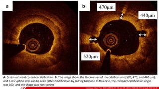SCORING
BALLOON
Cardiovasc Interv Ther. 2019 Jul;34(3):242-248. doi: 10.1007/s12928-018-0553-6. Epub 2018 Oct 19.
B
A: Cross-sectional coronary calcification. B: The image shows the thicknesses of the calcifications (520, 470, and 440 µm),
and 3 disruption sites can be seen (after modification by scoring balloon). In this case, the coronary calcification angle
was 360° and the shape was non-convex
 