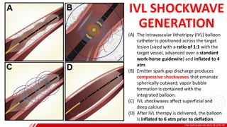 J Am Coll Cardiol Intv 2021;14:1275–92
B
(A) The intravascular lithotripsy (IVL) balloon
catheter is positioned across the target
lesion (sized with a ratio of 1:1 with the
target vessel, advanced over a standard
work-horse guidewire) and inflated to 4
atm
(B) Emitter spark gap discharge produces
compressive shockwaves that emanate
spherically outward; vapor bubble
formation is contained with the
integrated balloon.
(C) IVL shockwaves affect superficial and
deep calcium
(D) After IVL therapy is delivered, the balloon
is inflated to 6 atm prior to deflation.
IVL SHOCKWAVE
GENERATION
 