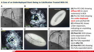 JACC: Asia. 2023 Apr, 3 (2) 185–197
B
(A) Pre-PCI CAG showing
diffuse ISR (in-stent
restenosis) in RCA
(B) Pre-IVL IVUS showing
the under-deployed
stent and calcified ISR
(C) Inflated NC shows
under-expansion,
indicating an unyielding
calcified lesion
(D) Post-IVL IVUS shows
some expansion of the
stent in the lesion
(E) The fully expanded
stent after IVL
(F) Post-PCI CAG showing
the fully expanded stents
 