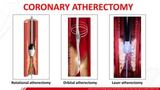CORONARY ATHERECTOMY
Interventional Cardiology Review 2019;14(3):182–9. DOI:https://doi.org/10.15420/icr.2019.17.R1
B
Rotational atherectomy Orbital atherectomy Laser atherectomy
 