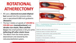 ROTATIONAL
ATHERECTOMY
Circ Cardiovasc Interv. 2021;14:e009870. DOI: 10.1161/CIRCINTERVENTIONS.120.009870
B
• RA uses a diamond encrusted elliptical
burr passed into the coronary artery
over a specialized 0.009 inch guidewire
(Rotawire)
• The burr rotates at speeds of 140.000 to
220.000 rpm (monodirectional) and
abrades non-elastic, fibro-calcified
tissue into small particles (<10 μm) while
deflecting off softer elastic tissue
• The debris from the lesion passes
downstream and cleared by the
reticuloendothelial system.
 