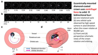 J. Pers. Med. 2022, 12, 1638. DOI: https://doi.org/10.3390/jpm12101638
B
Eccentrically mounted
diamond-coated
crown uses centrifugal
force to orbit →
bidirectional burr
(a) one rotational cycle
(b) one orbital cycle
observed by high-speed
camera in axial direction
when the crown rotates at
90,000 rpm
(c) front and (d)
perspective schematic
views of the crown
rotation and orbiting.
 