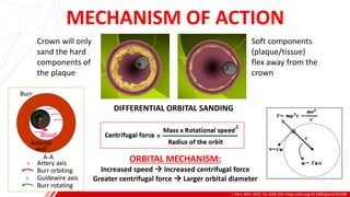 J. Pers. Med. 2022, 12, 1638. DOI: https://doi.org/10.3390/jpm12101638
B
MECHANISM OF ACTION
DIFFERENTIAL ORBITAL SANDING
Crown will only
sand the hard
components of
the plaque
Soft components
(plaque/tissue)
flex away from the
crown
ORBITAL MECHANISM:
Increased speed → Increased centrifugal force
Greater centrifugal force → Larger orbital diameter
 