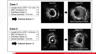 Calcium Modification Techniques in Complex PCI.pptx