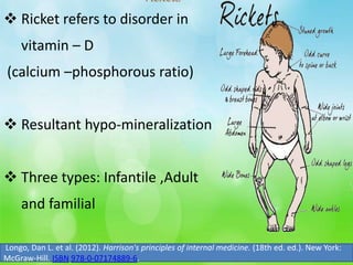  Ricket refers to disorder in
vitamin – D
(calcium –phosphorous ratio)
 Resultant hypo-mineralization
 Three types: Infantile ,Adult
and familial
rickets
Longo, Dan L. et al. (2012). Harrison's principles of internal medicine. (18th ed. ed.). New York:
McGraw-Hill. ISBN 978-0-07174889-6.
 