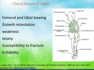 Femoral and tibial bowing
Growth retardation
weakness
tetany
Susceptibility to fracture
Irritability
Clinical features of rickets
Longo, Dan L. et al. (2012). Harrison's principles of internal medicine. (18th ed. ed.). New York:
McGraw-Hill. ISBN 978-0-07174889-6.
 
