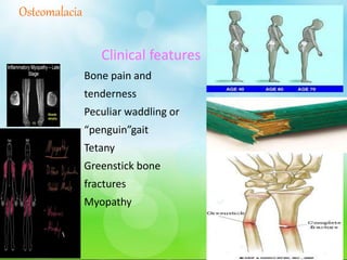 Osteomalacia
Clinical features
Bone pain and
tenderness
Peculiar waddling or
“penguin”gait
Tetany
Greenstick bone
fractures
Myopathy
 