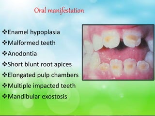 Oral manifestation
Enamel hypoplasia
Malformed teeth
Anodontia
Short blunt root apices
Elongated pulp chambers
Multiple impacted teeth
Mandibular exostosis
 