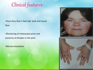 •Short (less than 5 feet tall) built and round
face.
•Shortening of metacarpal joints and
presence of dimples in the joint.
•Mental retardation
Clinical features
 
