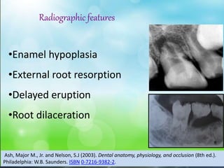 •Enamel hypoplasia
•External root resorption
•Delayed eruption
•Root dilaceration
Radiographic features
Ash, Major M., Jr. and Nelson, S.J (2003). Dental anatomy, physiology, and occlusion (8th ed.).
Philadelphia: W.B. Saunders. ISBN 0-7216-9382-2.
 