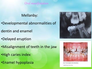 Oral manifestation
Mellanby:
•Developmental abnormalities of
dentin and enamel
•Delayed eruption
•Misalignment of teeth in the jaw
•High caries index
•Enamel hypoplasia
 