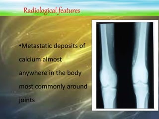 Radiological features
•Metastatic deposits of
calcium almost
anywhere in the body
most commonly around
joints
 