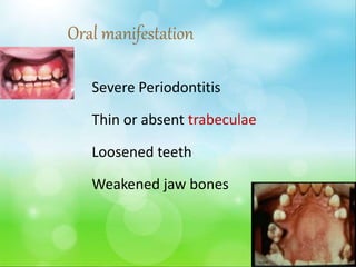 Severe Periodontitis
Thin or absent trabeculae
Loosened teeth
Weakened jaw bones
Oral manifestation
 