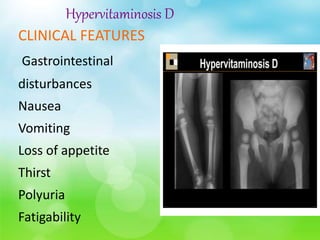 Hypervitaminosis D
CLINICAL FEATURES
Gastrointestinal
disturbances
Nausea
Vomiting
Loss of appetite
Thirst
Polyuria
Fatigability
 