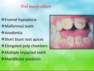 Oral manifestation
Enamel hypoplasia
Malformed teeth
Anodontia
Short blunt root apices
Elongated pulp chambers
Multiple impacted teeth
Mandibular exostosis
 
