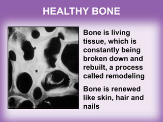 HEALTHY BONE
Bone is living
tissue, which is
constantly being
broken down and
rebuilt, a process
called remodeling
Bone is renewed
like skin, hair and
nails
 