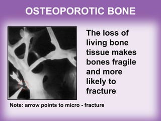 OSTEOPOROTIC BONE
The loss of
living bone
tissue makes
bones fragile
and more
likely to
fracture
Note: arrow points to micro - fracture
 