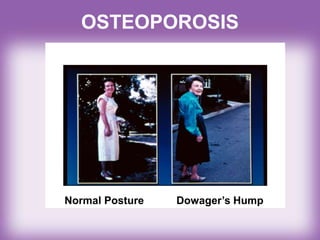 OSTEOPOROSIS
Normal Posture Dowager’s Hump
 