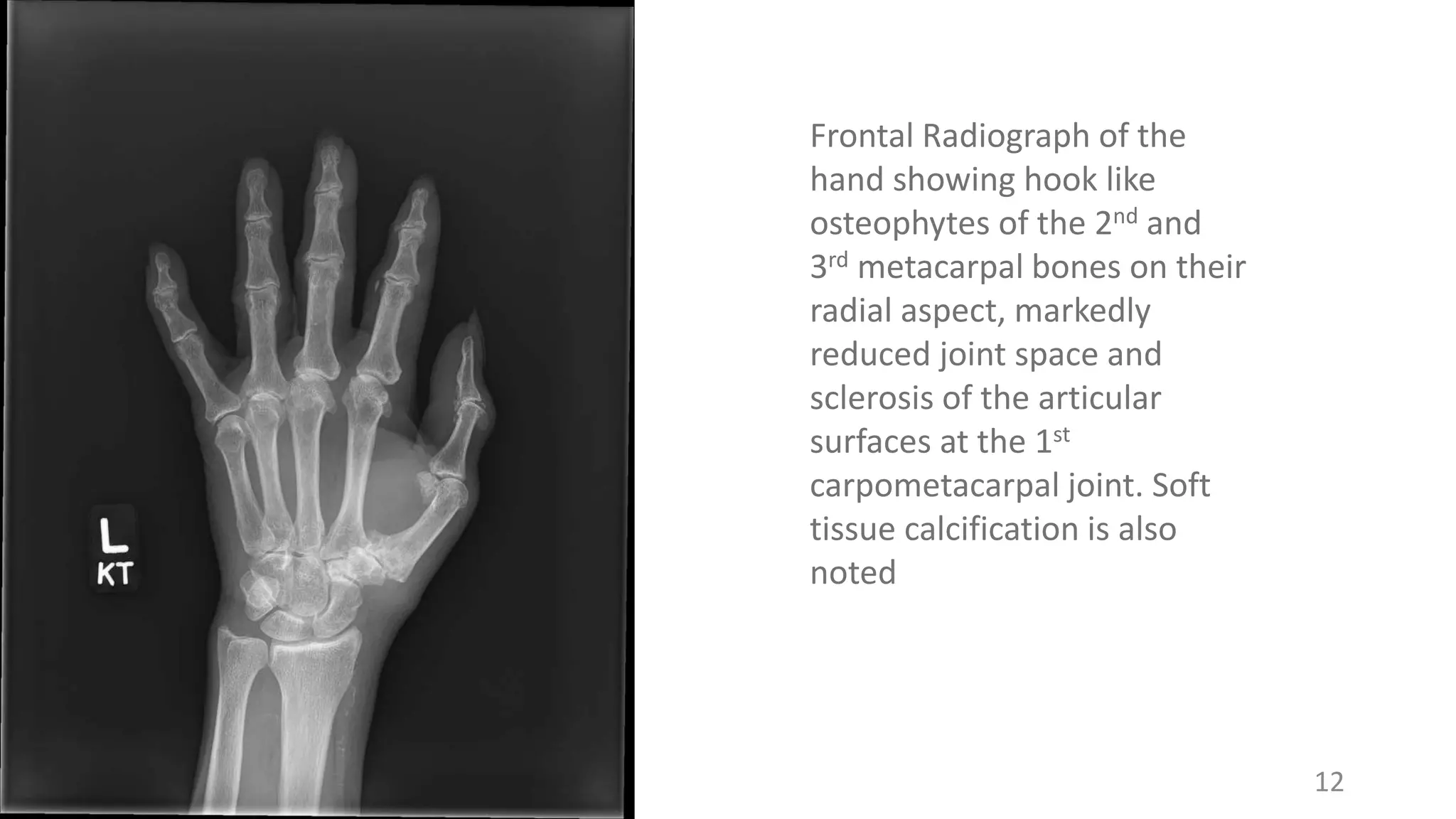 12
Frontal Radiograph of the
hand showing hook like
osteophytes of the 2nd and
3rd metacarpal bones on their
radial aspect, markedly
reduced joint space and
sclerosis of the articular
surfaces at the 1st
carpometacarpal joint. Soft
tissue calcification is also
noted
 