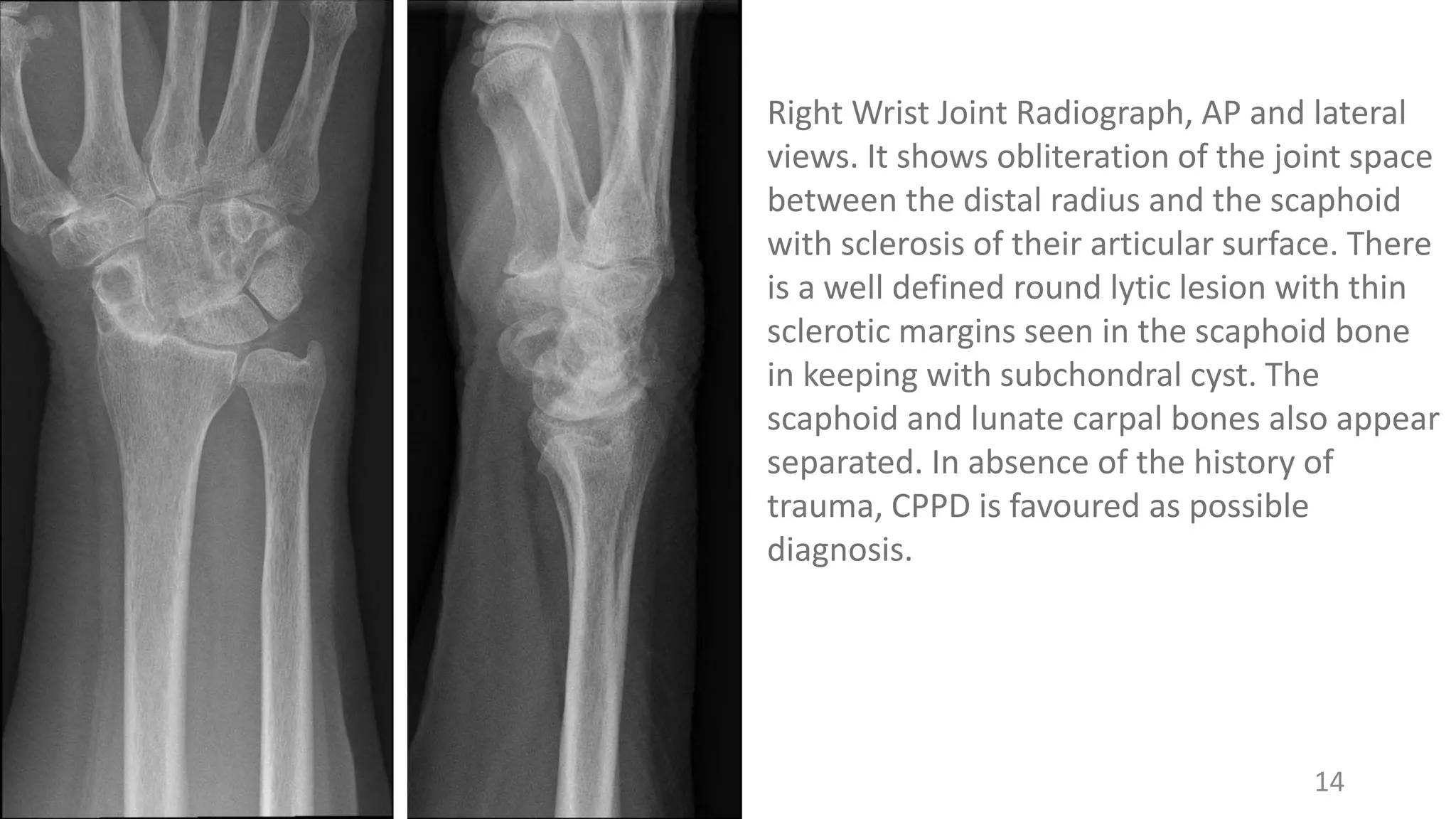 14
Right Wrist Joint Radiograph, AP and lateral
views. It shows obliteration of the joint space
between the distal radius and the scaphoid
with sclerosis of their articular surface. There
is a well defined round lytic lesion with thin
sclerotic margins seen in the scaphoid bone
in keeping with subchondral cyst. The
scaphoid and lunate carpal bones also appear
separated. In absence of the history of
trauma, CPPD is favoured as possible
diagnosis.
 