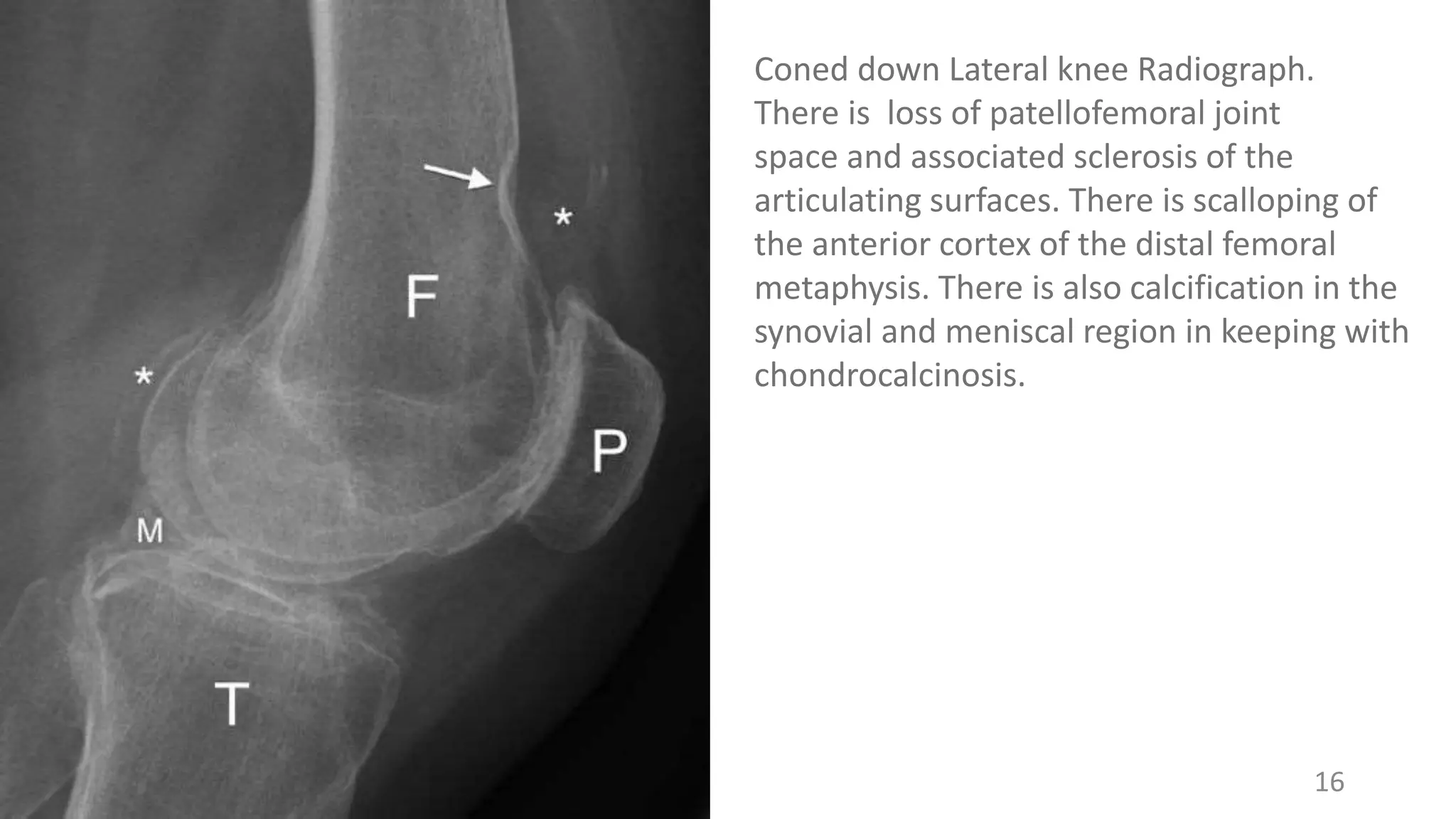 16
Coned down Lateral knee Radiograph.
There is loss of patellofemoral joint
space and associated sclerosis of the
articulating surfaces. There is scalloping of
the anterior cortex of the distal femoral
metaphysis. There is also calcification in the
synovial and meniscal region in keeping with
chondrocalcinosis.
 