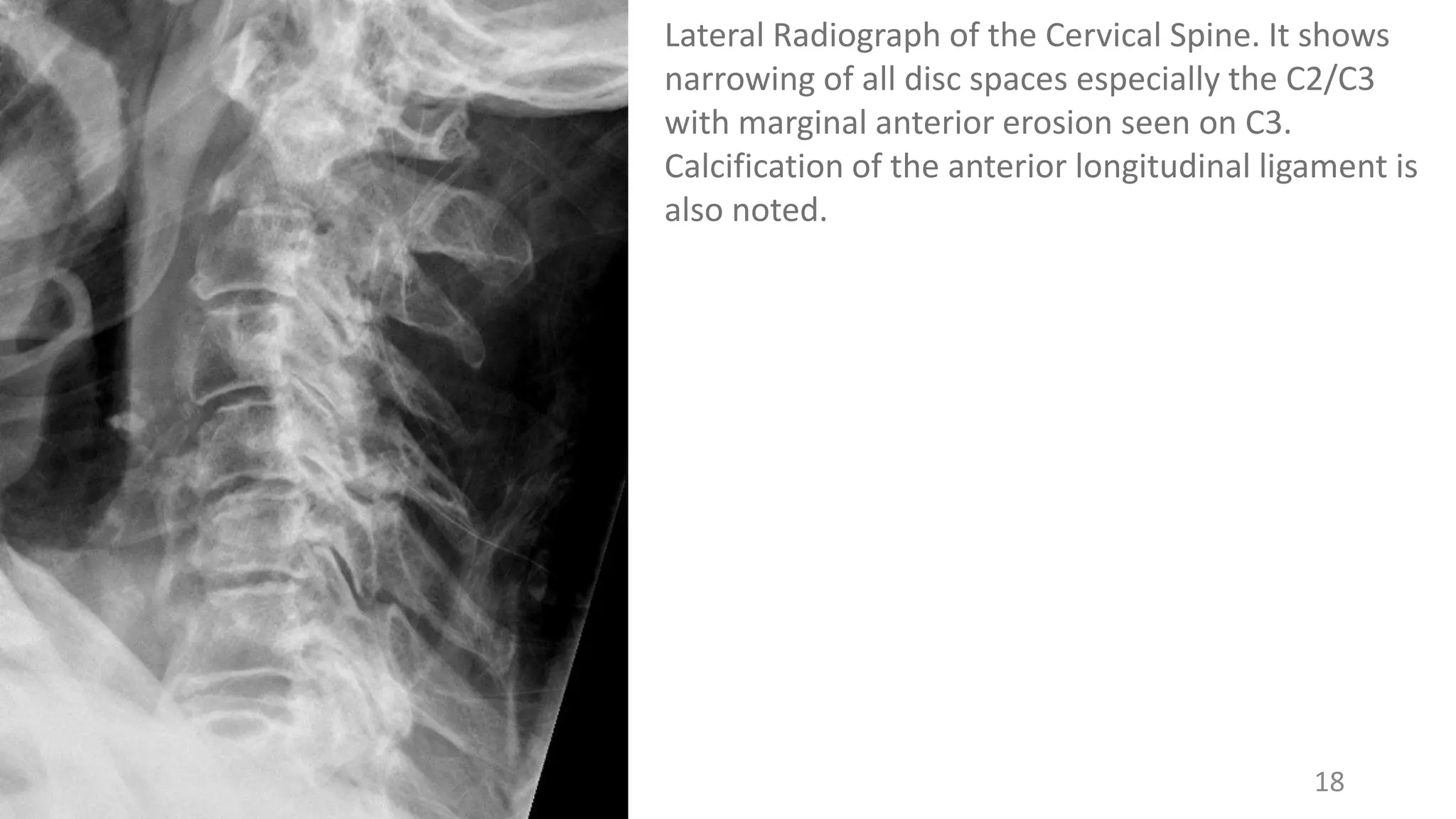 18
Lateral Radiograph of the Cervical Spine. It shows
narrowing of all disc spaces especially the C2/C3
with marginal anterior erosion seen on C3.
Calcification of the anterior longitudinal ligament is
also noted.
 