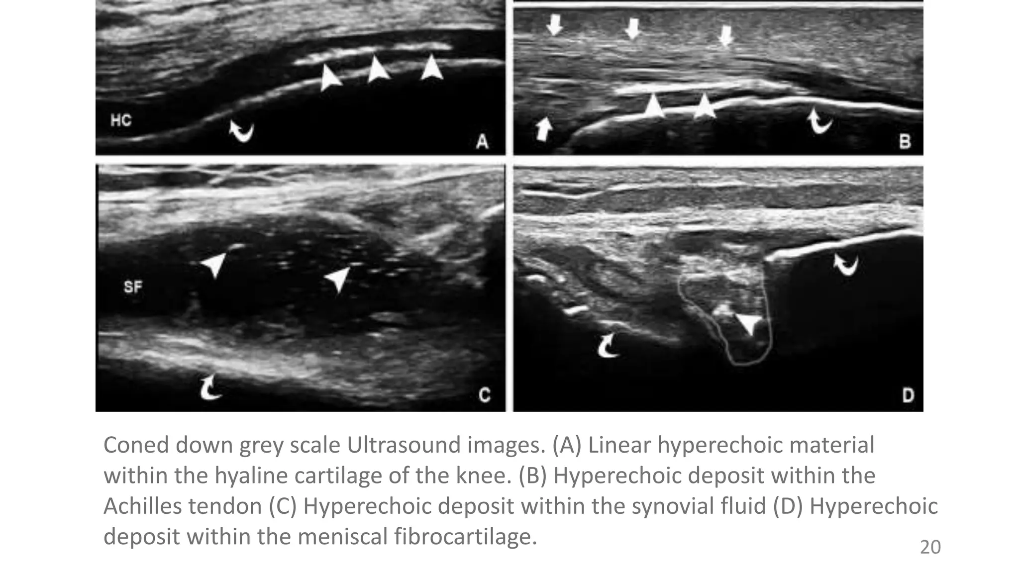 20
Coned down grey scale Ultrasound images. (A) Linear hyperechoic material
within the hyaline cartilage of the knee. (B) Hyperechoic deposit within the
Achilles tendon (C) Hyperechoic deposit within the synovial fluid (D) Hyperechoic
deposit within the meniscal fibrocartilage.
 