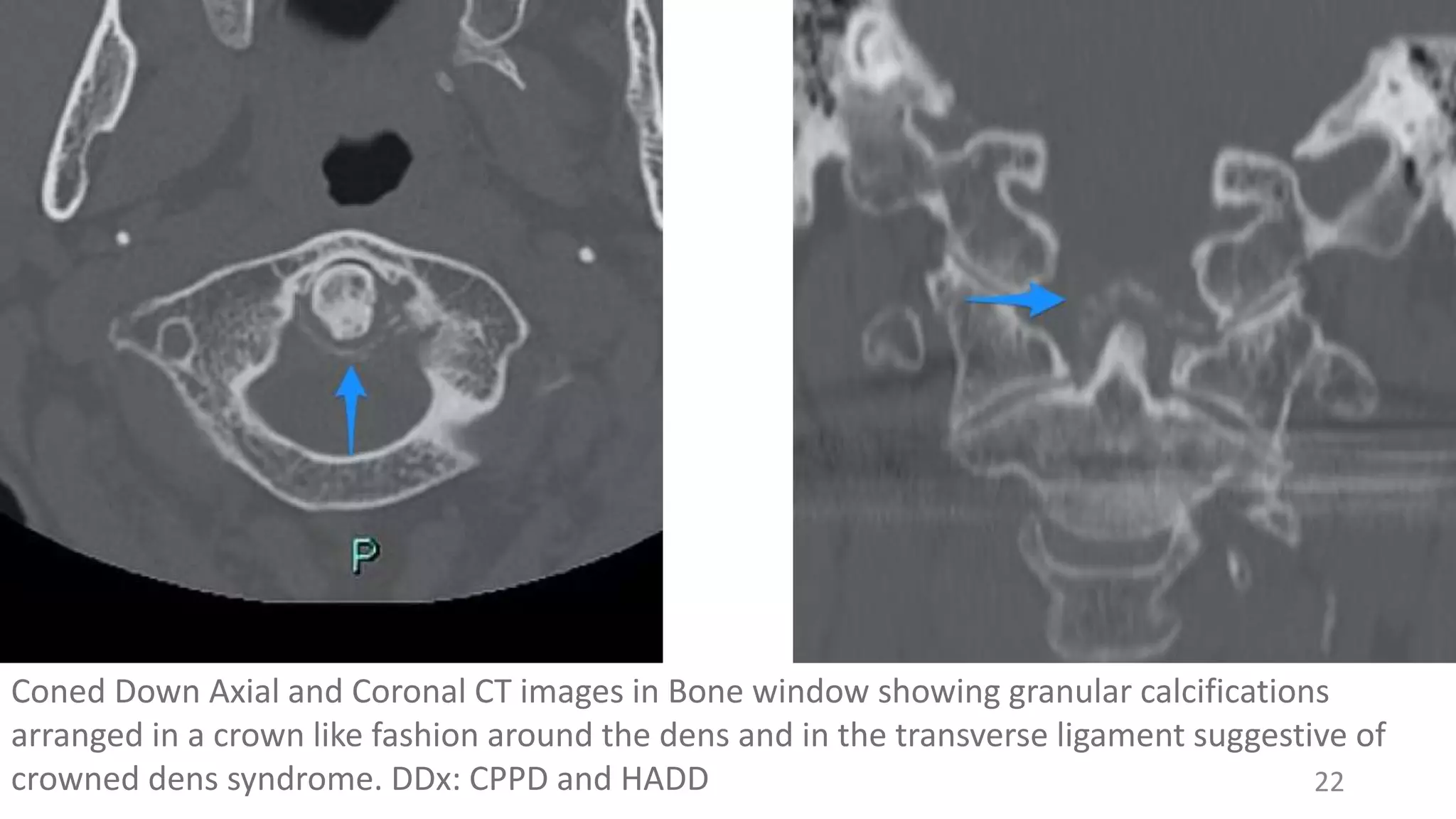 22
Coned Down Axial and Coronal CT images in Bone window showing granular calcifications
arranged in a crown like fashion around the dens and in the transverse ligament suggestive of
crowned dens syndrome. DDx: CPPD and HADD
 