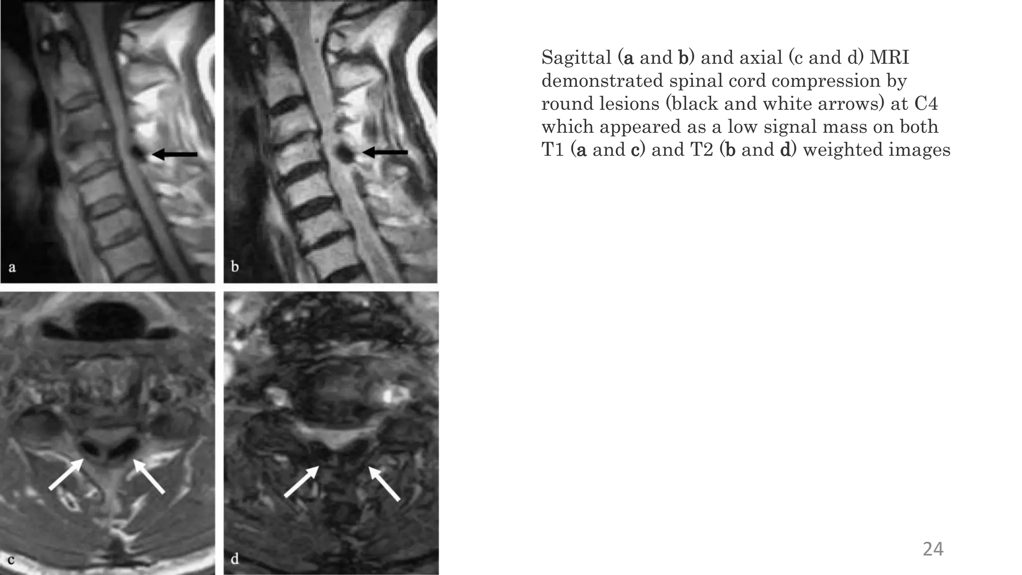 24
Sagittal (a and b) and axial (c and d) MRI
demonstrated spinal cord compression by
round lesions (black and white arrows) at C4
which appeared as a low signal mass on both
T1 (a and c) and T2 (b and d) weighted images
 