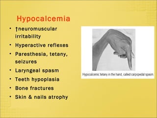 Hypocalcemia
• ↑neuromuscular
irritability
• Hyperactive reflexes
• Paresthesia, tetany,
seizures
• Laryngeal spasm
• Teeth hypoplasia
• Bone fractures
• Skin & nails atrophy
 