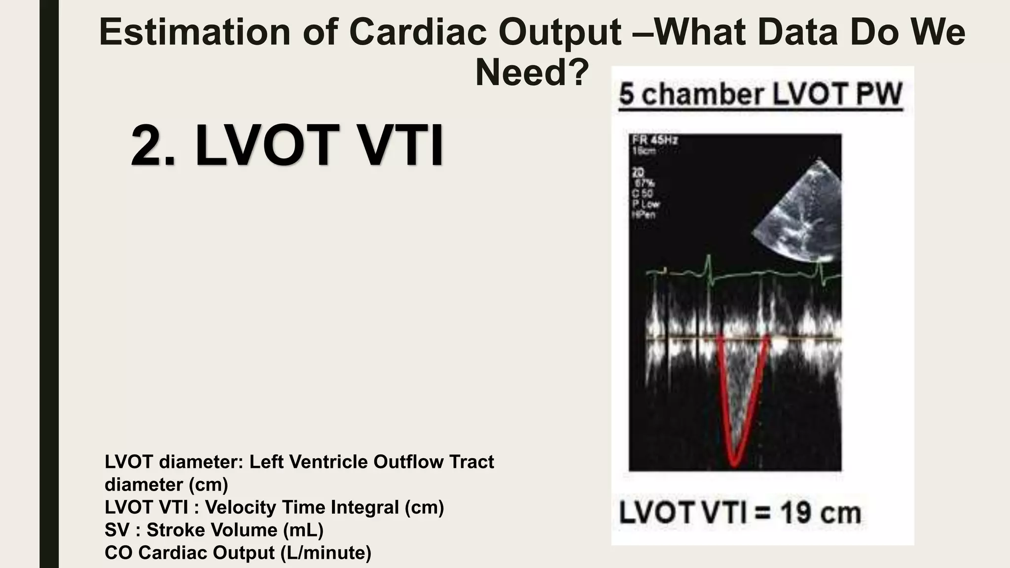 Estimation of Cardiac Output –What Data Do We
Need?
2. LVOT VTI
LVOT diameter: Left Ventricle Outflow Tract
diameter (cm)
LVOT VTI : Velocity Time Integral (cm)
SV : Stroke Volume (mL)
CO Cardiac Output (L/minute)
 