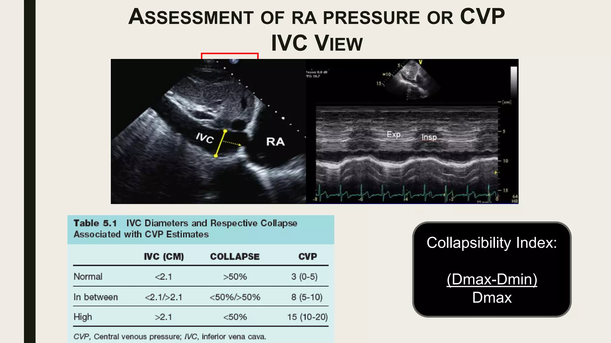 SNIFF
Collapsibility Index:
(Dmax-Dmin)
Dmax
ASSESSMENT OF RA PRESSURE OR CVP
IVC VIEW
 