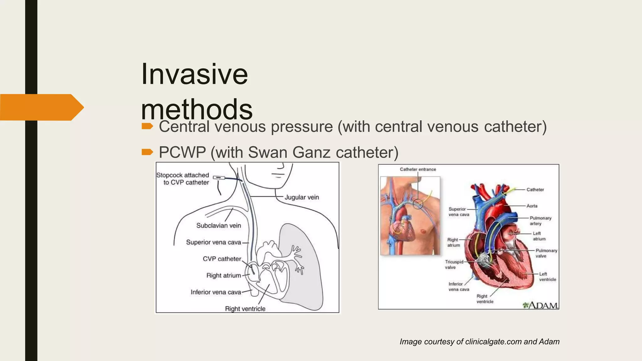 Invasive
methods
 Central venous pressure (with central venous catheter)
 PCWP (with Swan Ganz catheter)
Image courtesy of clinicalgate.com and Adam
 