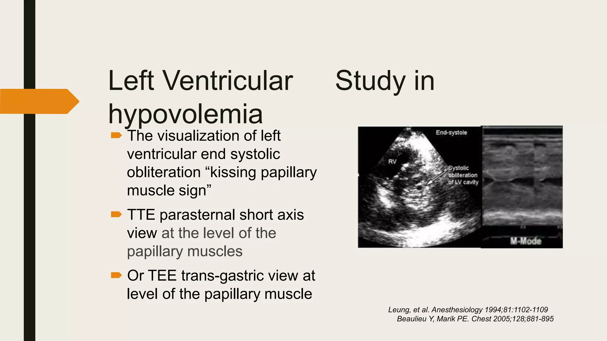Left Ventricular Study in
hypovolemia
 The visualization of left
ventricular end systolic
obliteration “kissing papillary
muscle sign”
 TTE parasternal short axis
view at the level of the
papillary muscles
 Or TEE trans-gastric view at
level of the papillary muscle
Leung, et al. Anesthesiology 1994;81:1102-1109
Beaulieu Y, Marik PE. Chest 2005;128;881-895
 
