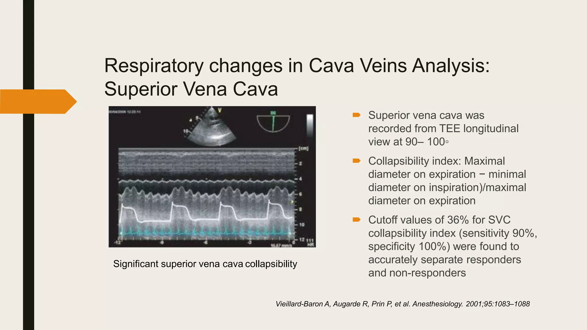 Respiratory changes in Cava Veins Analysis:
Superior Vena Cava
 Superior vena cava was
recorded from TEE longitudinal
view at 90– 100◦
 Collapsibility index: Maximal
diameter on expiration − minimal
diameter on inspiration)/maximal
diameter on expiration
 Cutoff values of 36% for SVC
collapsibility index (sensitivity 90%,
specificity 100%) were found to
accurately separate responders
and non-responders
Vieillard-Baron A, Augarde R, Prin P, et al. Anesthesiology. 2001;95:1083–1088
Significant superior vena cava collapsibility
 
