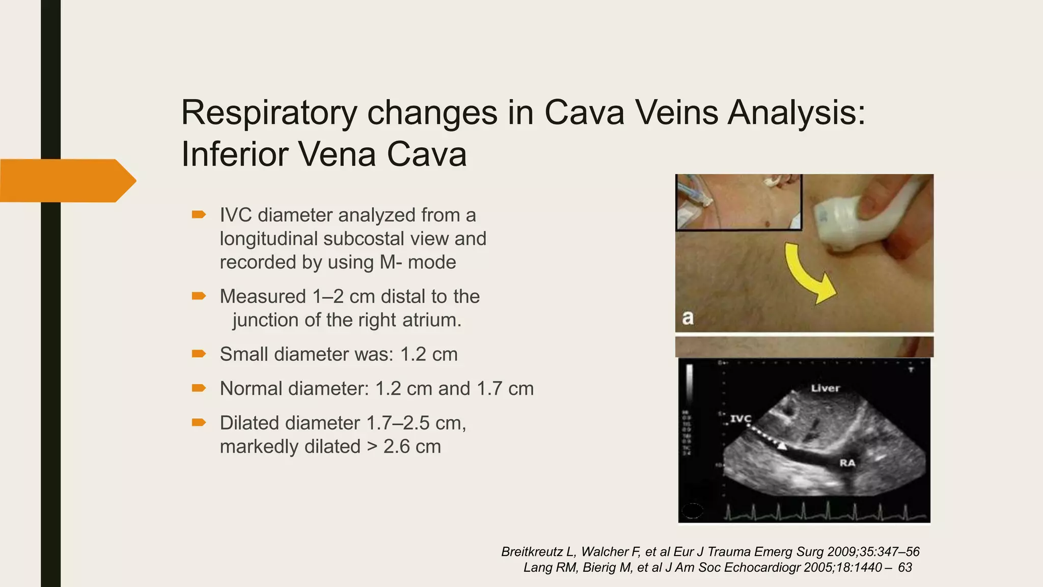 Respiratory changes in Cava Veins Analysis:
Inferior Vena Cava
 IVC diameter analyzed from a
longitudinal subcostal view and
recorded by using M- mode
 Measured 1–2 cm distal to the
junction of the right atrium.
 Small diameter was: 1.2 cm
 Normal diameter: 1.2 cm and 1.7 cm
 Dilated diameter 1.7–2.5 cm,
markedly dilated > 2.6 cm
Breitkreutz L, Walcher F, et al Eur J Trauma Emerg Surg 2009;35:347–56
Lang RM, Bierig M, et al J Am Soc Echocardiogr 2005;18:1440 – 63
 