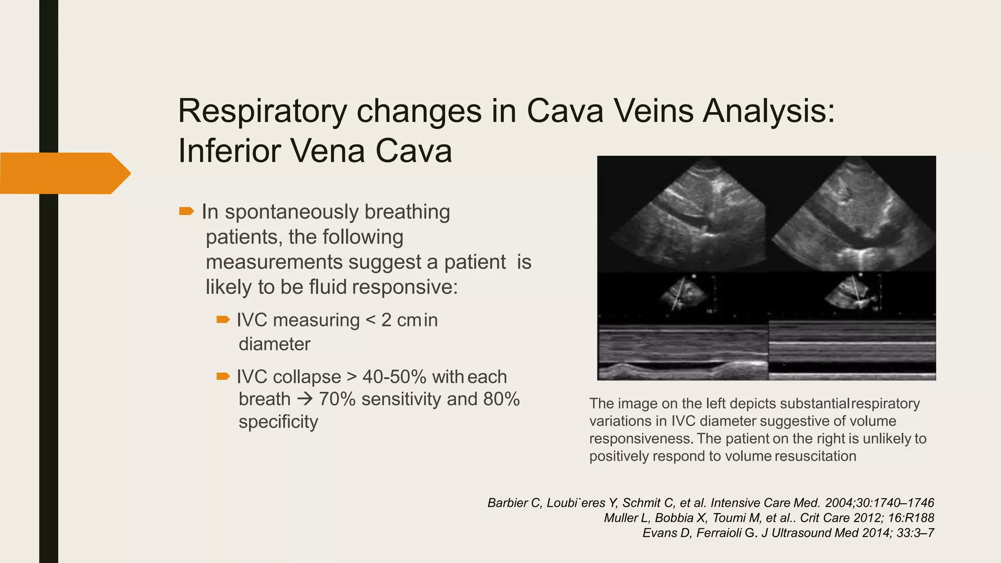 Respiratory changes in Cava Veins Analysis:
Inferior Vena Cava
 In spontaneously breathing
patients, the following
measurements suggest a patient is
likely to be fluid responsive:
 IVC measuring < 2 cmin
diameter
 IVC collapse > 40-50% witheach
breath  70% sensitivity and 80%
specificity
Barbier C, Loubi`eres Y, Schmit C, et al. Intensive Care Med. 2004;30:1740–1746
Muller L, Bobbia X, Toumi M, et al.. Crit Care 2012; 16:R188
Evans D, Ferraioli G. J Ultrasound Med 2014; 33:3–7
The image on the left depicts substantialrespiratory
variations in IVC diameter suggestive of volume
responsiveness. The patient on the right is unlikely to
positively respond to volume resuscitation
 
