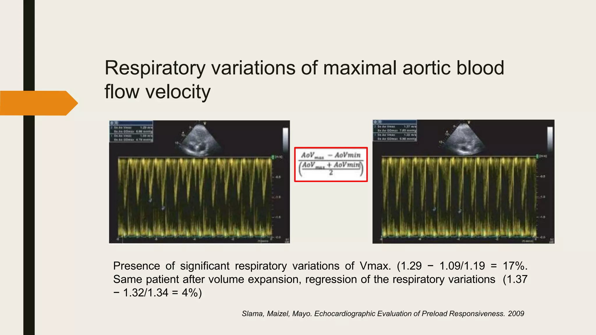 Respiratory variations of maximal aortic blood
flow velocity
Presence of significant respiratory variations of Vmax. (1.29 − 1.09/1.19 = 17%.
Same patient after volume expansion, regression of the respiratory variations (1.37
− 1.32/1.34 = 4%)
Slama, Maizel, Mayo. Echocardiographic Evaluation of Preload Responsiveness. 2009
 