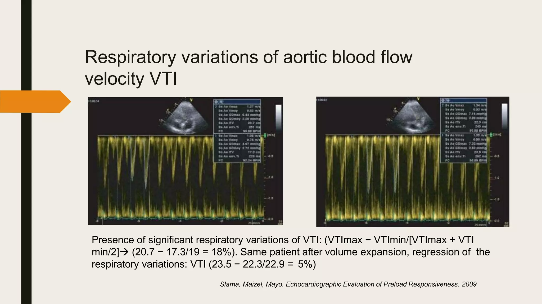 Respiratory variations of aortic blood flow
velocity VTI
Presence of significant respiratory variations of VTI: (VTImax − VTImin/[VTImax + VTI
min/2] (20.7 − 17.3/19 = 18%). Same patient after volume expansion, regression of the
respiratory variations: VTI (23.5 − 22.3/22.9 = 5%)
Slama, Maizel, Mayo. Echocardiographic Evaluation of Preload Responsiveness. 2009
 