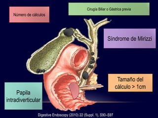Número de cálculos
Tamaño del
cálculo > 1cm
Cirugía Biliar o Gástrica previa
Síndrome de Mirizzi
Papila
intradiverticular
Digestive Endoscopy (2010) 22 (Suppl. 1), S90–S97
 
