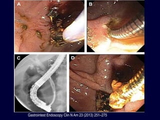 Gastrointest Endoscopy Clin N Am 23 (2013) 251–275
 