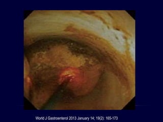 World J Gastroenterol 2013 January 14; 19(2): 165-173
 