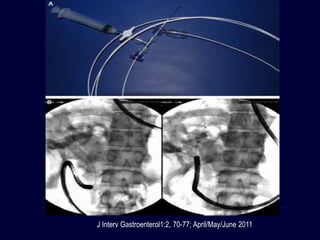 J Interv Gastroenterol1:2, 70-77; April/May/June 2011
 